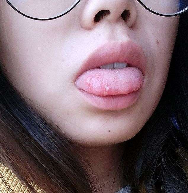 舌尖上有四个口腔溃疡是一种什么体验!