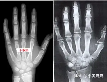 在骨骺线闭合之前,骺软骨不断分裂增殖生成新的软骨,然后软骨变成骨