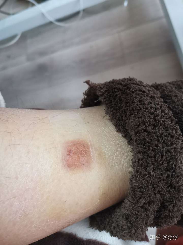 艾灸烫伤没有戳破,多长时间能恢复?