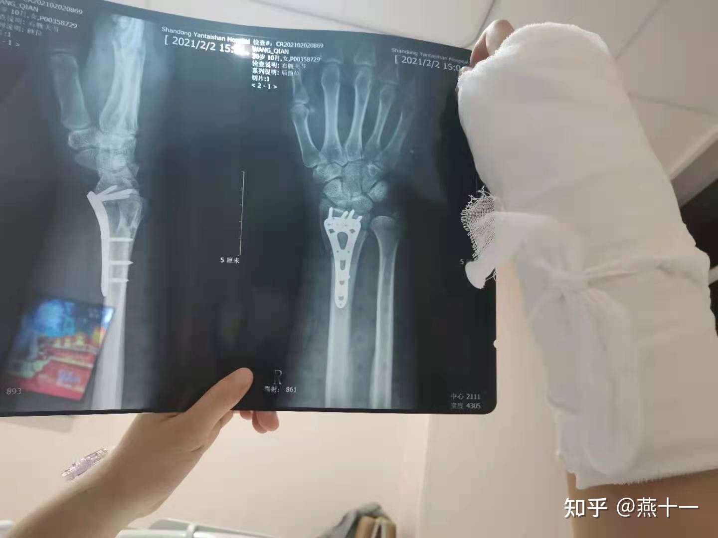 写个手腕粉碎性骨折康复吧 供大家参考 知乎