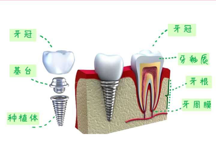 种植牙有哪些坏处?