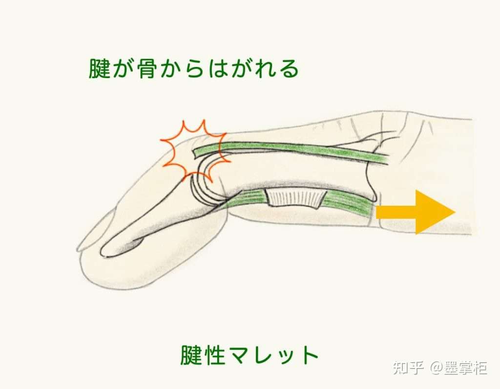 锤状指 背伸肌腱损伤 治疗记录 知乎