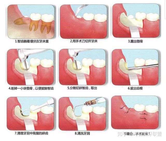 最全的智齿大揭秘 看看你有没中枪 知乎