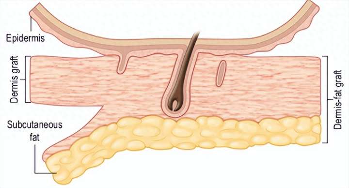 为什么余文林博士做耳再造尽量不植皮?