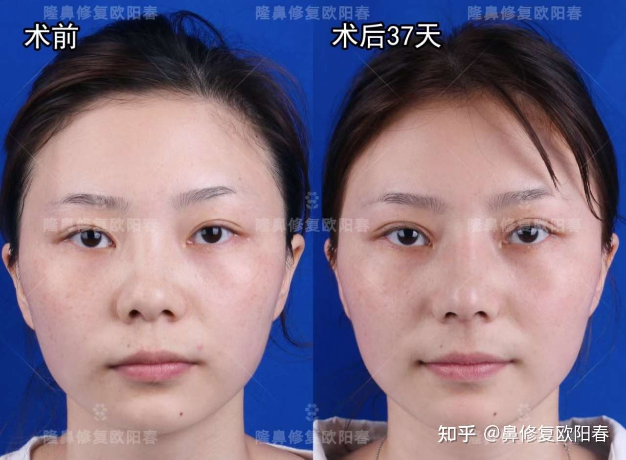 全肋鼻综合61术后37天对比反馈