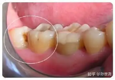 拔牙最怕的就是感染,尤其是智齒,若沒有精心的維護,很容易出現幹槽症