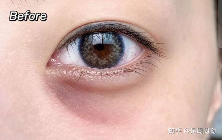 泪沟型黑眼圈能去除么?可以缓解么?