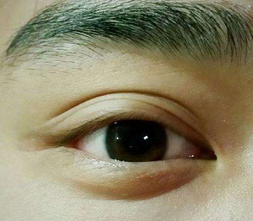 双眼皮整形可导致失明 重睑术并发症讲解 知乎