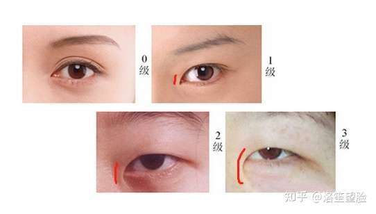 又或是内眦赘皮,0级属于正常,1级是轻度,2级是中度,3级是重度.
