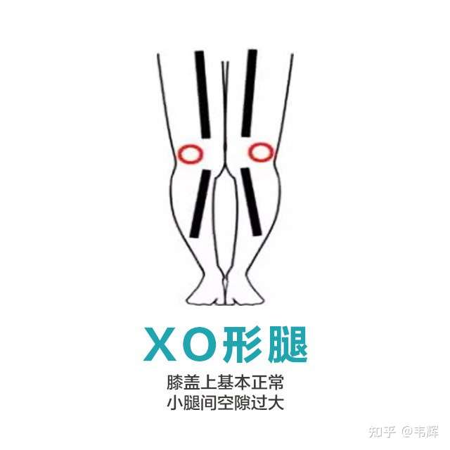 照片看你还好,相对没有xo型腿,你小腿中间有缝隙但也属于正常的情况