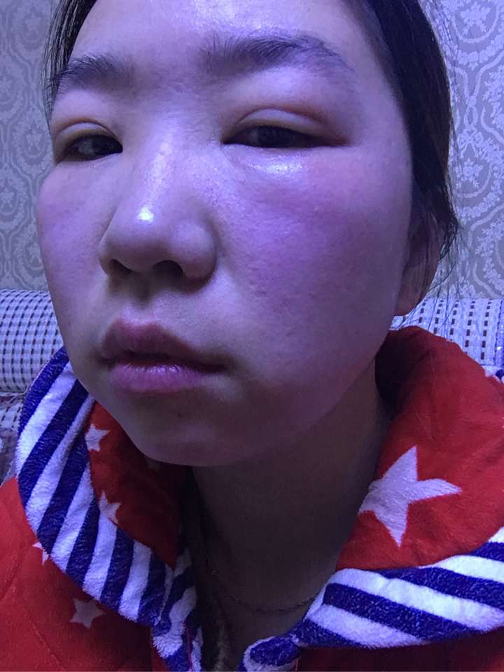 有没有人用有油的倩碧黄油过敏的?