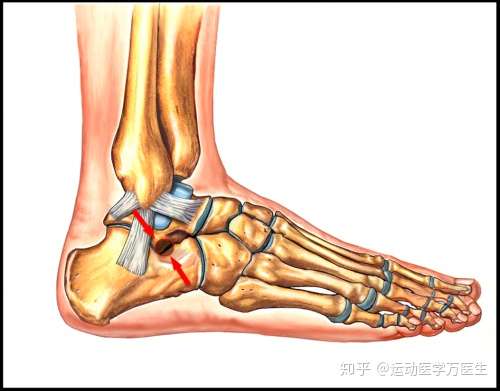 29人 赞同了该文章 这个地方叫跗骨窦 运动医学万医生:脚踝扭伤成习惯