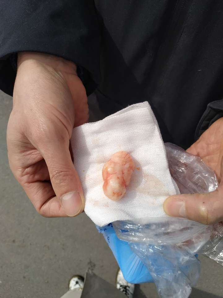 有没有女孩子得过乳腺纤维瘤啊?