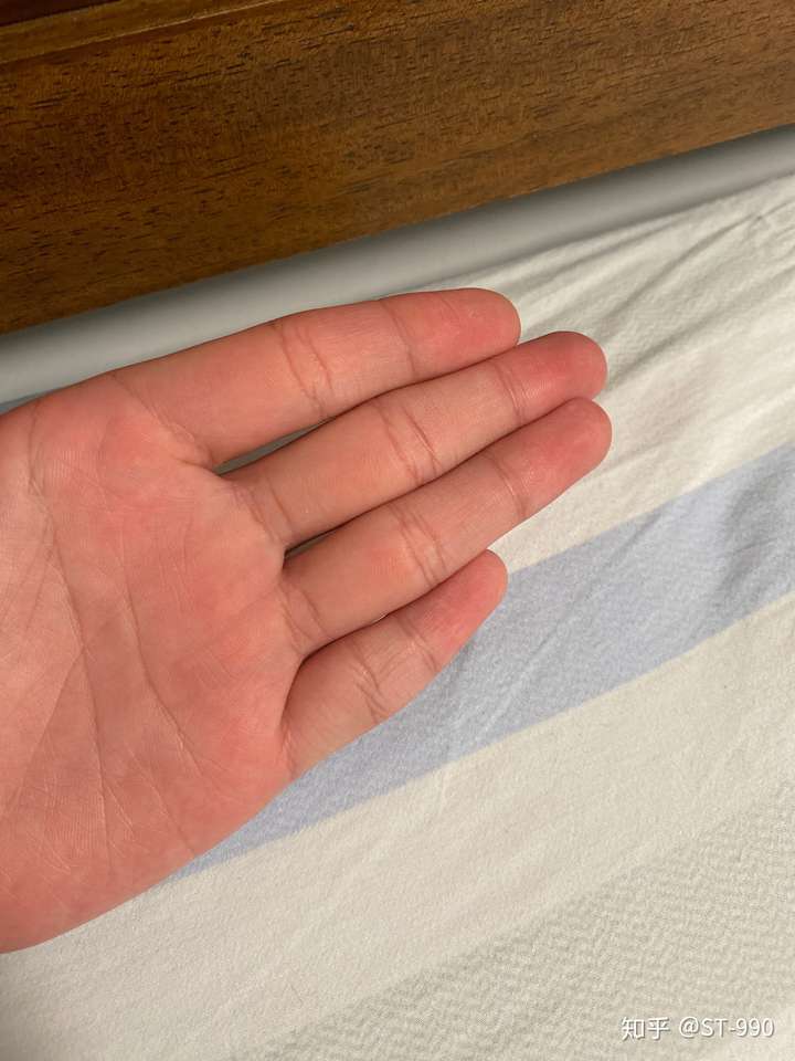 左手小拇指受过伤 短一点 能学好吉他吗?