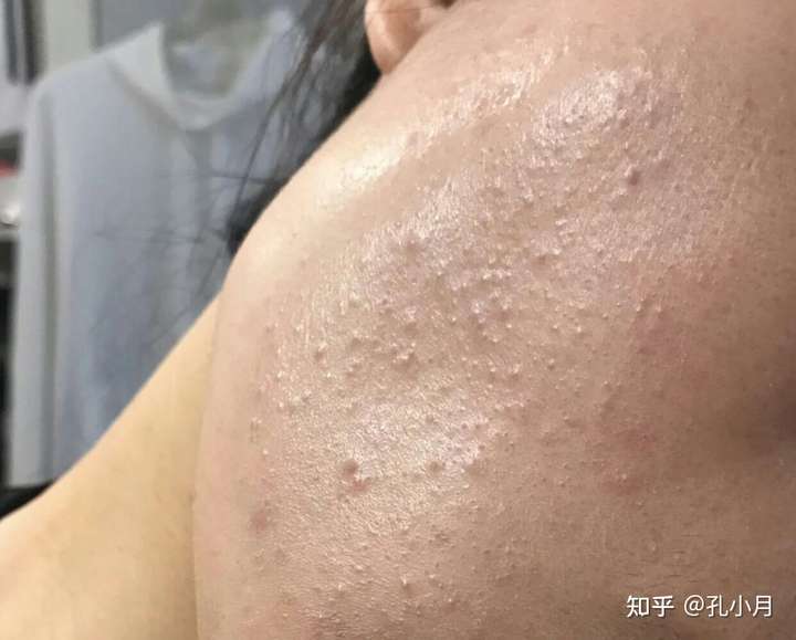 我爆闭口最厉害的时候是因为去游泳,因为脸太敏感了,一下闭口全爆出来