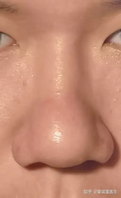 鼻头圆怎么缩小