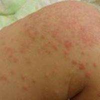 过敏性皮炎 知乎