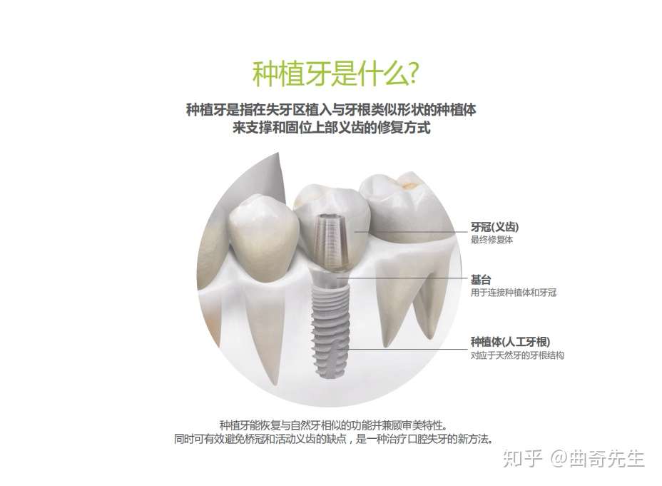 种植牙品牌大全 怎么选择种植牙品牌 知乎