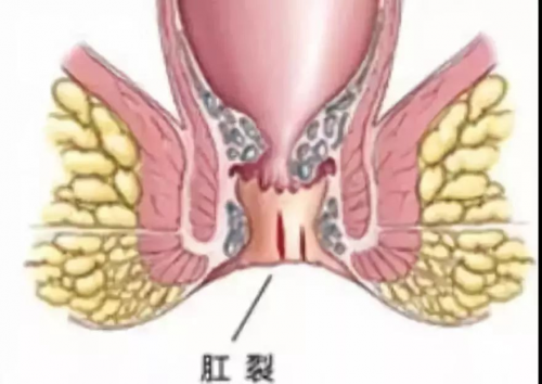 广州东大肛肠医院可靠吗不要让肛裂撕毁我们的生活