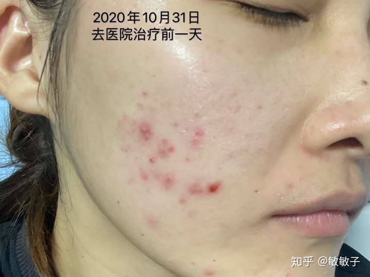 去医院做了火针刷酸后的痘痘为什么感觉更严重了