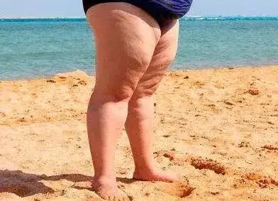 首先我要说一下,吸脂不是所有人都适合的,吸脂是国外医生为过度肥胖的