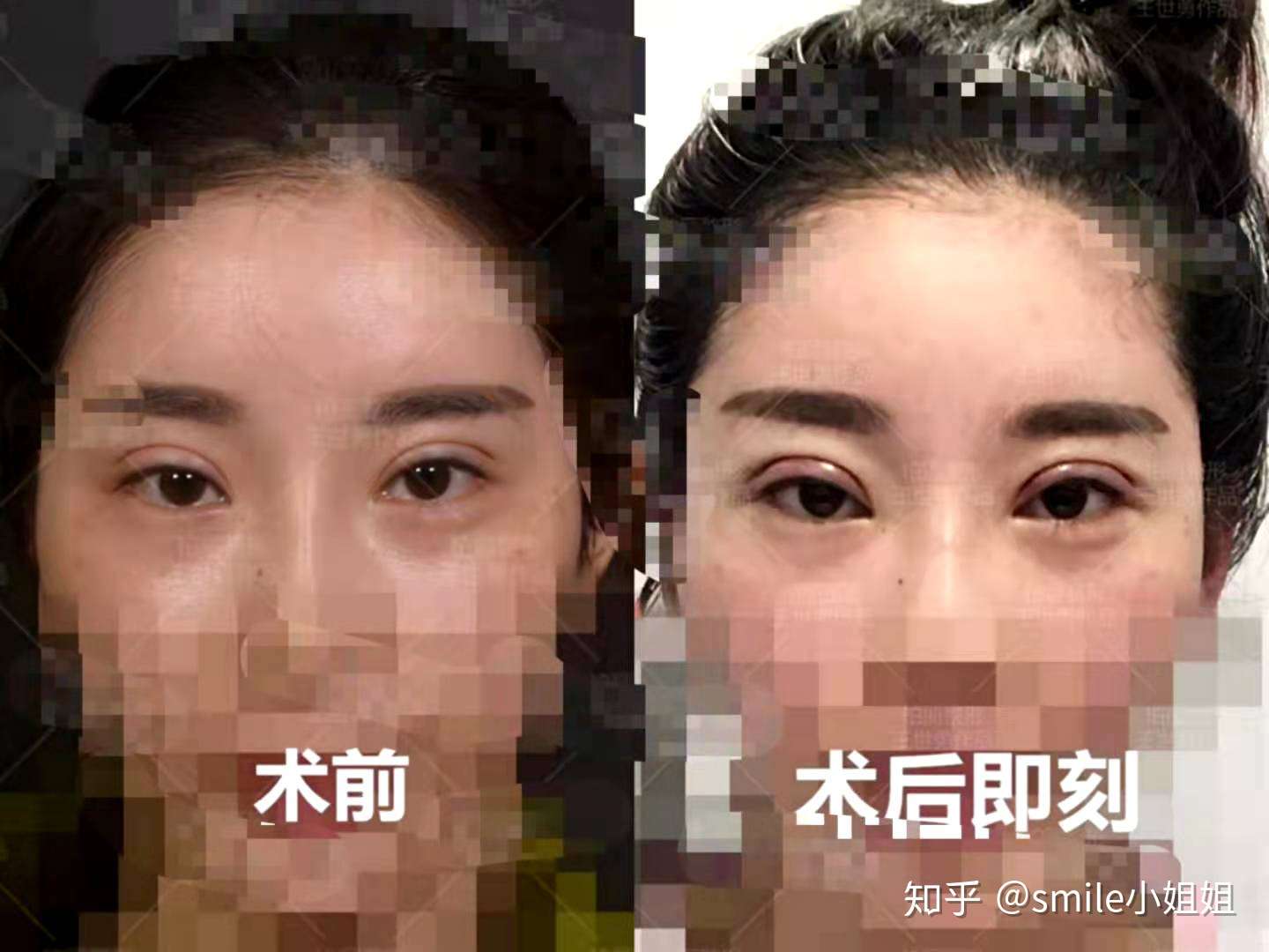 双眼皮修复 内行人才知道的 全国知名修复医生深度分析 知乎