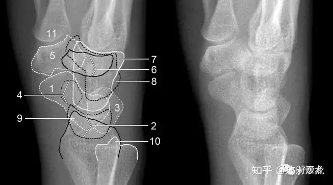 赞！腕关节X线高清解剖+腕骨脱位典型病例- 知乎