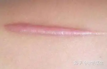 增生性疤痕多久可以变平? - 知乎