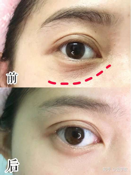 笑的时候眼角出现明显皱纹怎样去皱