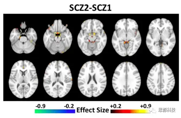 BRAIN：利用机器学习揭示了两种精神分裂症的神经解剖学亚型- 知乎