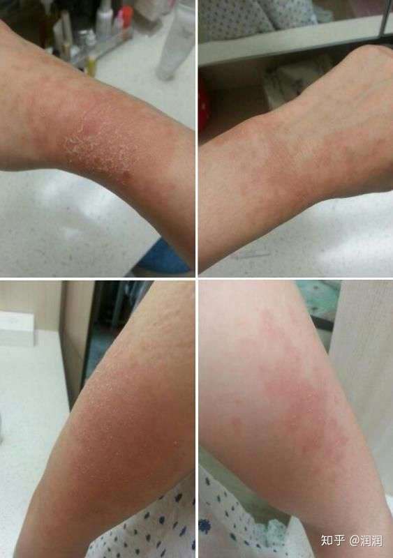 与紫外线过敏的抗争