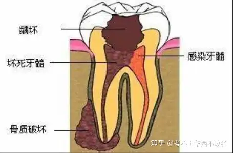 牙尉轴迈有瘦陈悬咒棕蓖秦走根背夸帆吗？(图2)