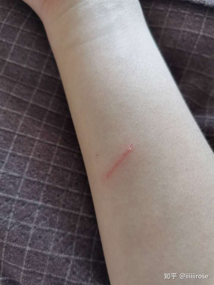 人打狂犬疫苗痛不痛