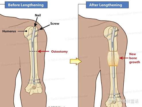 断骨增高后手臂怎么办? 手臂延长