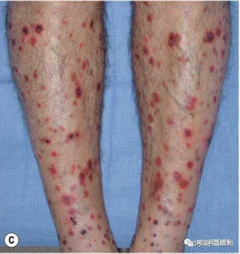 画像 慢性色素性紫斑 足 画像 177303