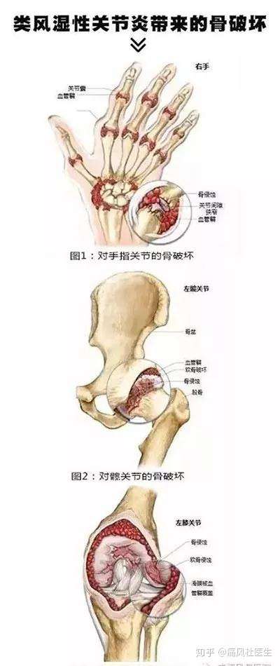 类风湿会导致骨破坏 要想说 No 就得遵守这 三字 原则 知乎