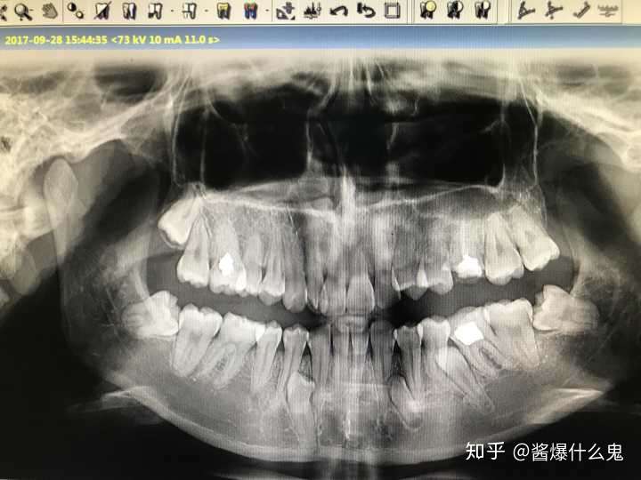 这样的上颌埋伏牙,拔出难度大吗?风险呢?