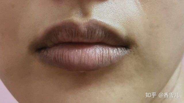 如何解决唇周暗沉情况?
