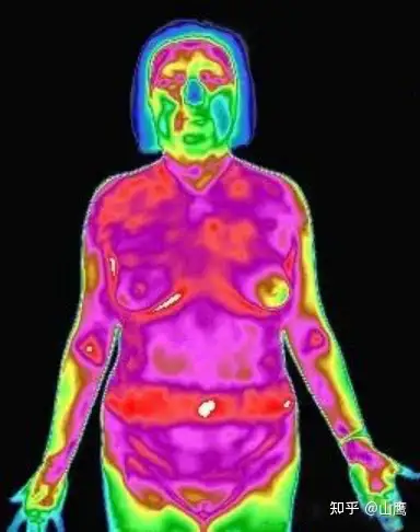 红外热成像在中医领域应用研究中医九种体质之阴虚体质血瘀体质痰湿