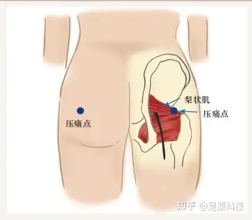 梨状肌体表定位图片