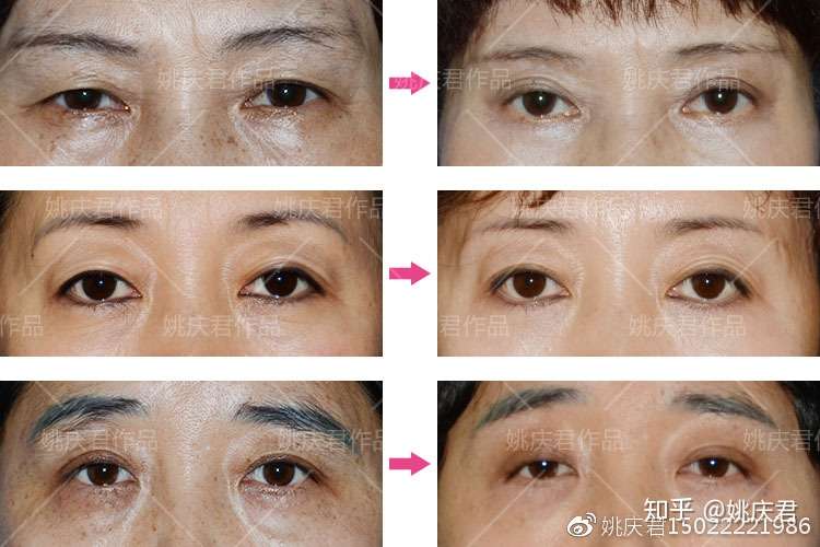 中老年面部年轻化手术 一 上睑下垂的修复 知乎