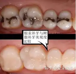 补牙材料很多,但总体而言可以分为四大类,分别为银汞合金,玻璃离子