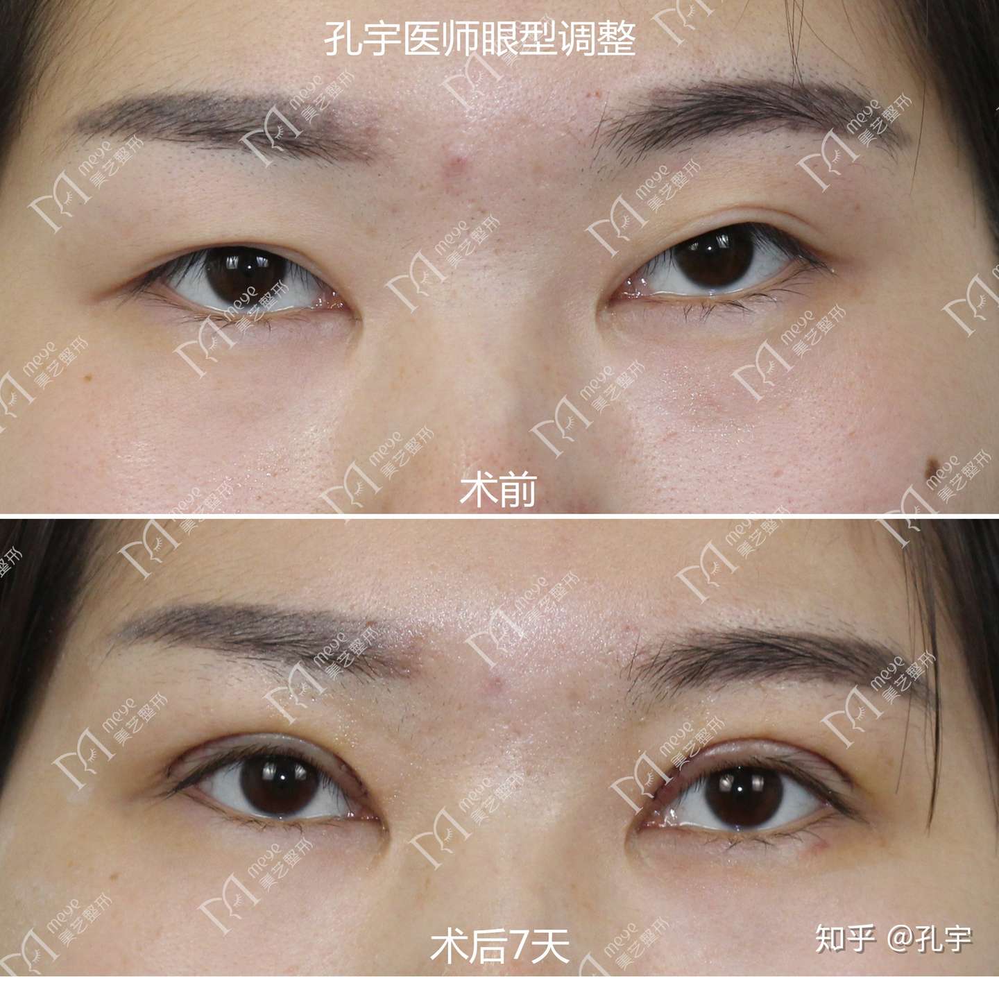 眼型调整你知道多少 知乎 眼型调整你知道多少 知乎