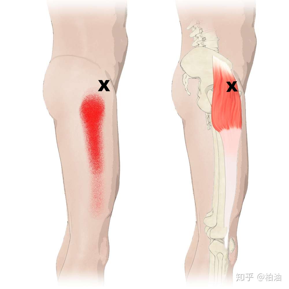 如何放松阔筋膜张肌 改善骨盆前倾 髋内旋 知乎