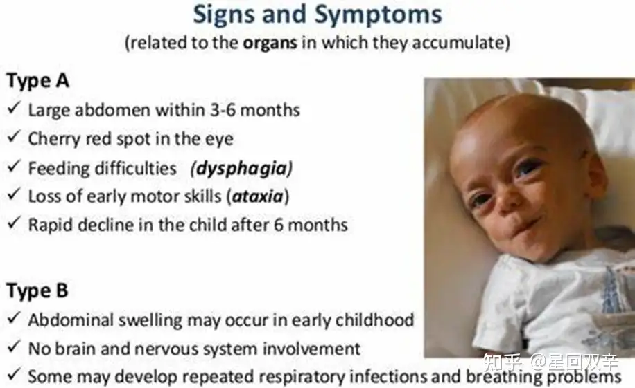 Niemann Pick Disease (Nafisa Nawal Islam)