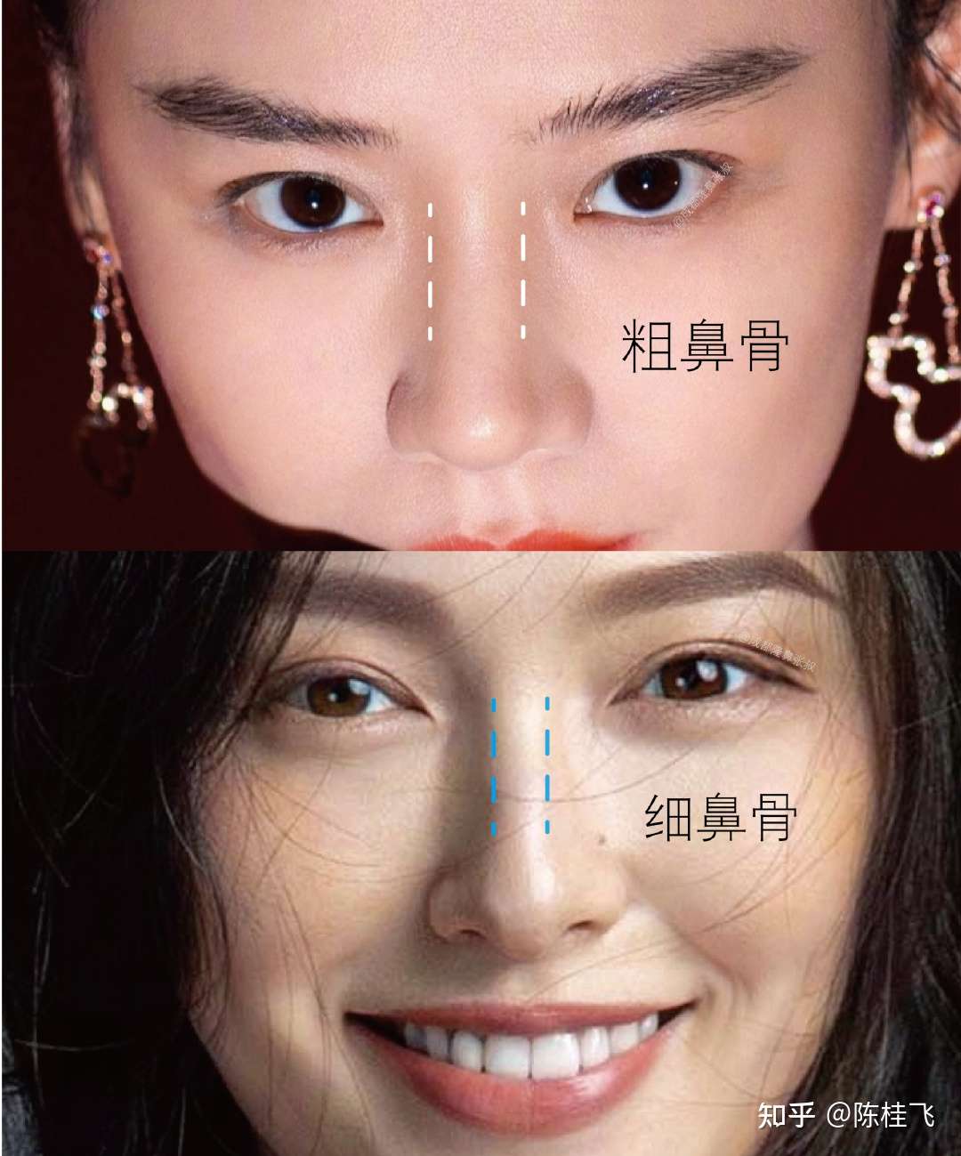 鼻骨粗和鼻骨宽是一样的吗 知乎