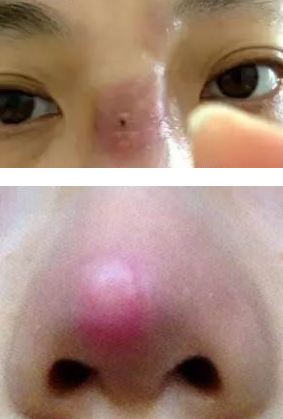 玻尿酸隆鼻失败案例(这是两个人两张图)