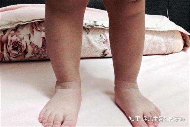 如何正确认识和治疗孩子的八字脚？