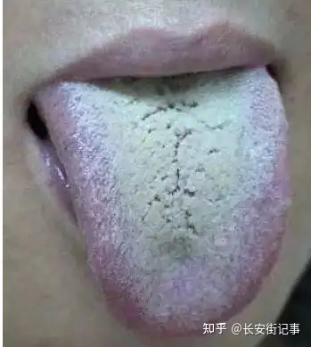 舌苔厚白中间有裂痕到底人体哪些地方出现疾病了