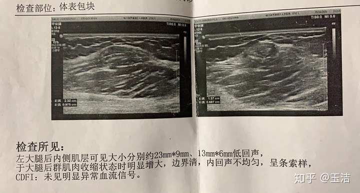 大腿后侧鼓了个大包,医生说是肌疝?